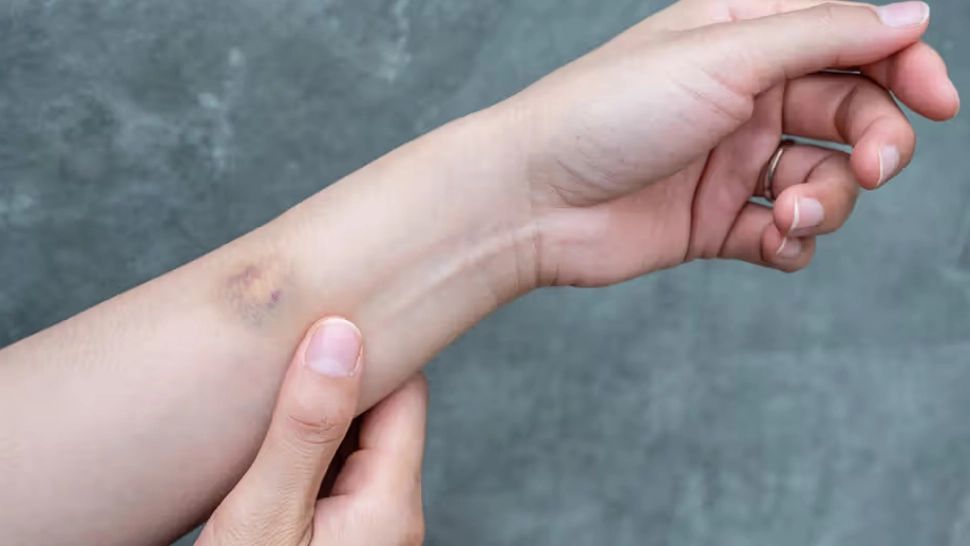 Vânătăile ce apar din senin, semnal de alarmă - Alte simptome ale lipsei de vitamine K și C - Remedii naturale