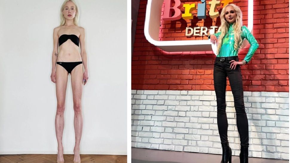 Femeia care și-a lungit picioarele cu 14 centimetri. A cheltuit o avere, dar acum regretă