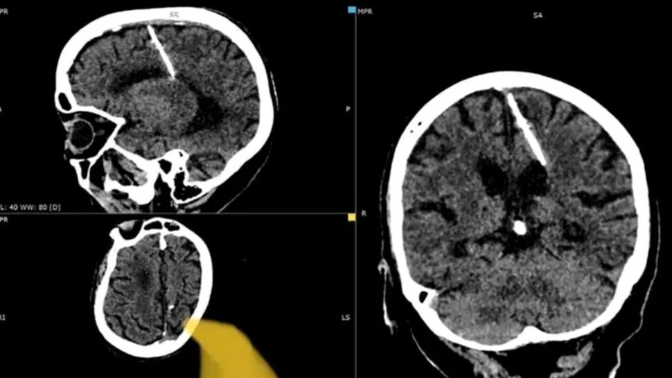 Ac de cusut, găsit în creierul unei femei, după 80 de ani. Teoria cumplită prin care i-ar fi ajuns în cap