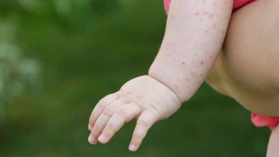 ALERTĂ în România - Epidemie de RUJEOLĂ la nivel național, declarată de Ministerul Sănătății - Cifre alarmante: 2.000 de cazuri în 29 de județe