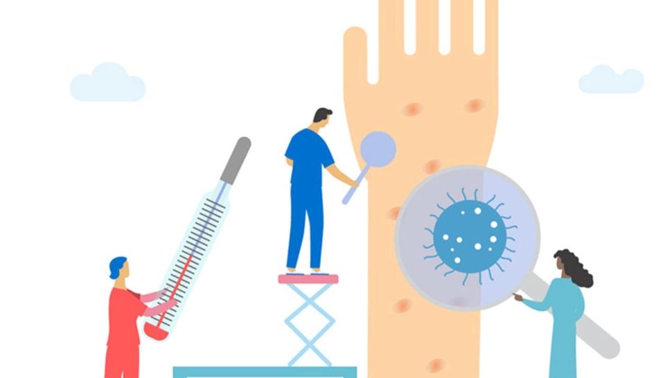 Epidemie de rujeolă, în România. Ce este rujeola, cum se manifestă și cum se transmite: virusul, extrem de contagios