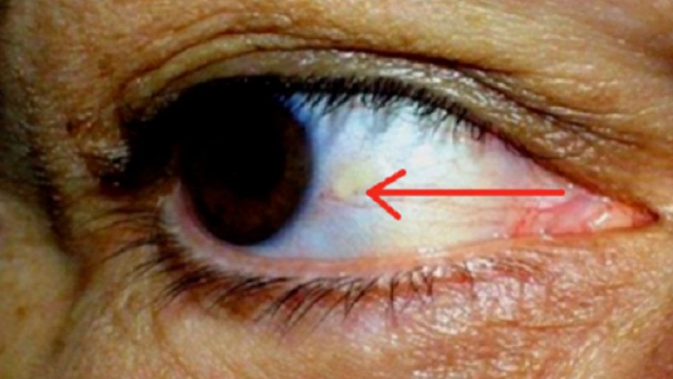 Dacă ți-a apărut așa ceva în ochi, fugi la doctor. Ce probleme grave de sănătate indică acest simptom