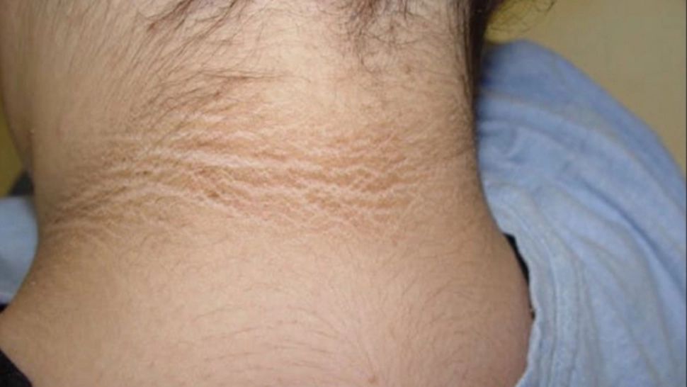 Dacă ai semnele acestea pe gât, sub ceafă, e bine să îți faci analizele. Sunt primul simptom al unei boli grave