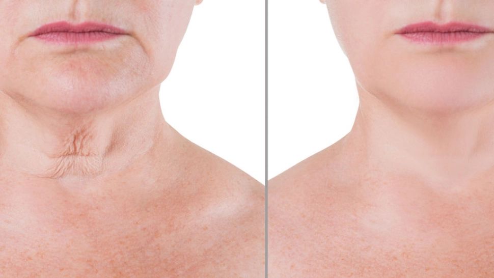  Tot ce trebuie să știi despre "gâtul de curcan". Cum se poate preveni apariția lui