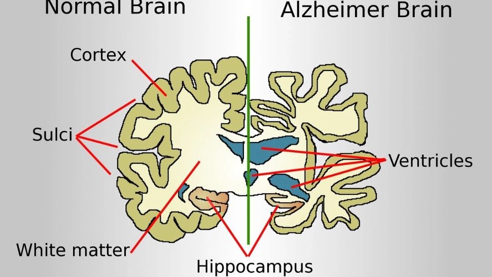 Vești bune în medicină: Instrumentul AI care prezice boala Alzheimer din tiparele de vorbire
