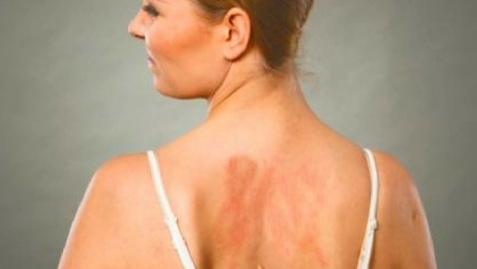 Alergia la soare este mai periculoasă decât se crede. Cum să o recunoști și cum să o ții sub control 