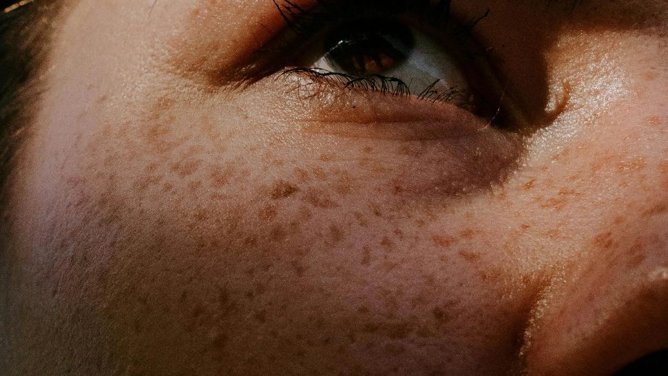 Cum poți scăpa de pistrui și petele solare inestetice. Metode naturale și la îndemâna oricui