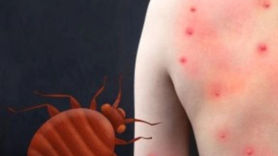 Semne că ai fost mușcat de ploșnițe. Cum să le deosebești de celelalte mușcături de insecte și cum să le tratezi