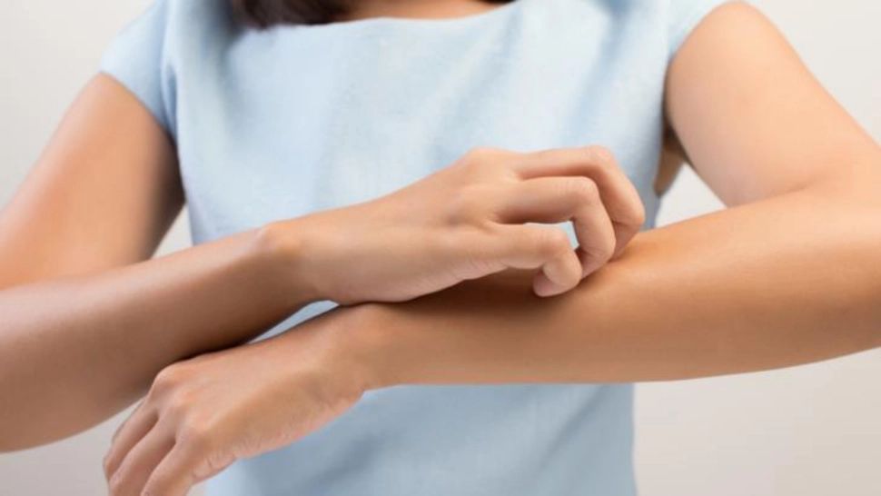 Erupțiile cutanate care îi pun dificultate pe dermatologi pot fi, de fapt, intoleranță la histamină. Când ar trebui să ne îngrijoreze reacțiile 