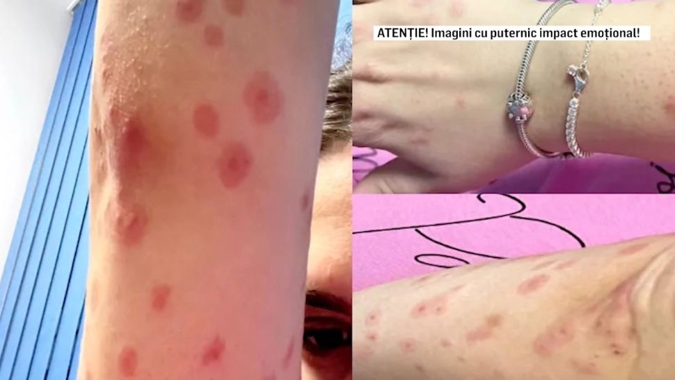 Incident grav, în căminele din Regie: o studentă a ajuns la spital din cauza mușcăturilor de ploșnițe! Administrația, reacție șoc: ”O nespălată!” - FOTO