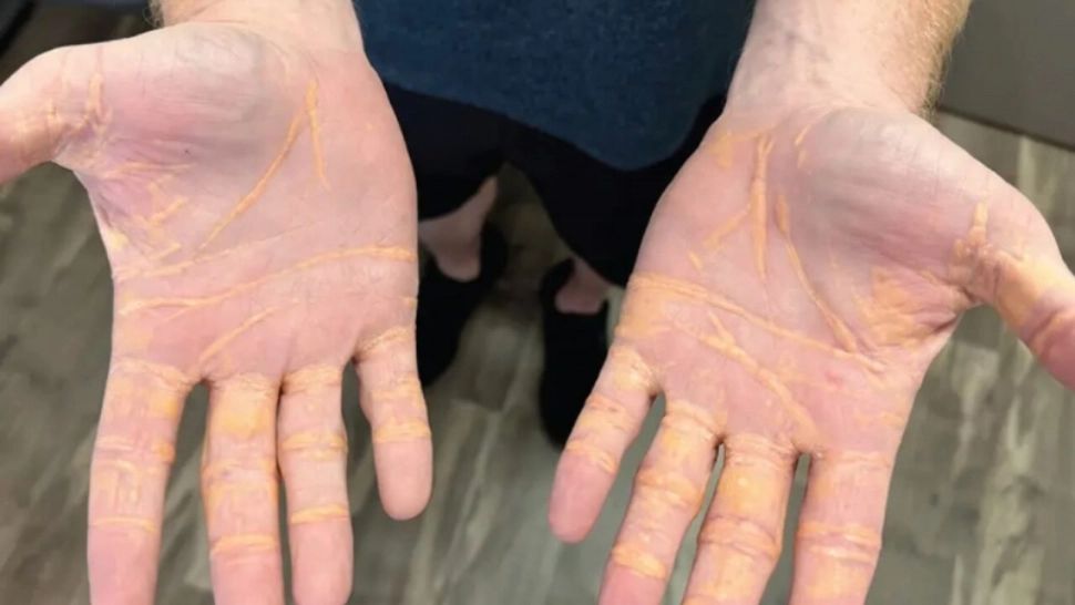 Colesterolul i-a invadat organismul după opt luni de dietă extremă. A mâncat doar ouă, carne și brânză