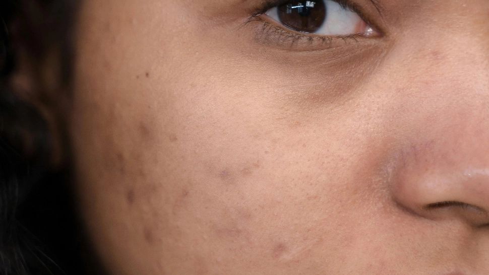 Cele mai bune remedii naturale care ajută la vindecarea cicatricilor, inclusiv a celor de acnee. Netezesc pielea și o catifelează și sunt la îndemâna oricui