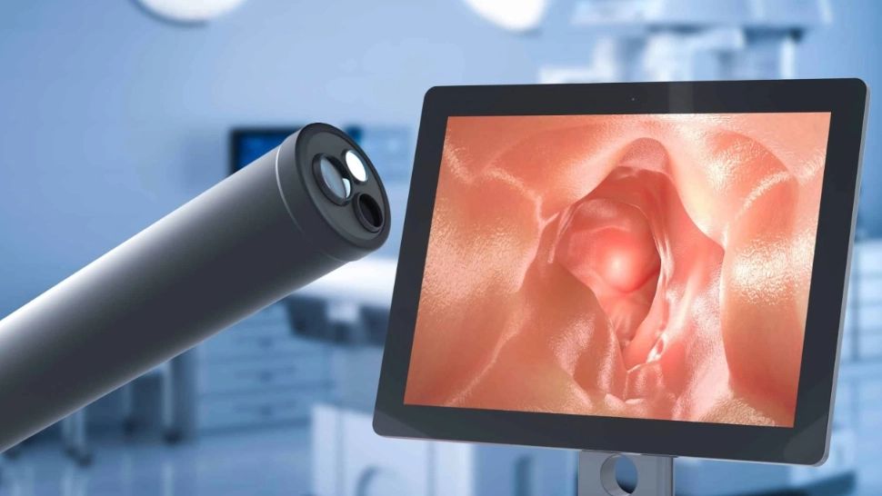 De ce trebuie îndepărtați polipii colonici