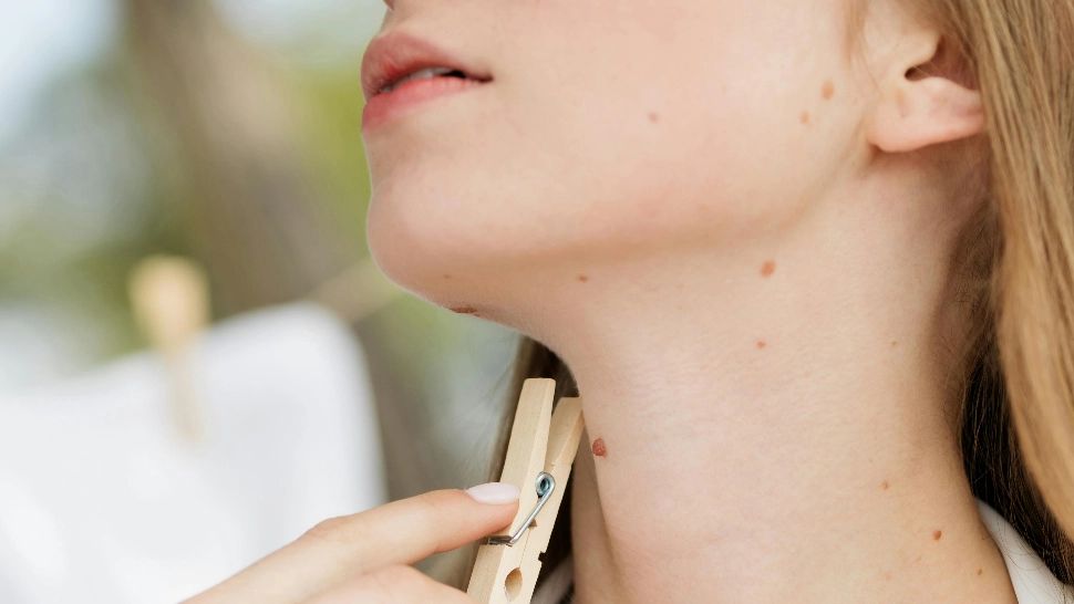 Ce semnificație au alunițele de pe frunte. Semnele din naștere dau indicii despre destinul tău