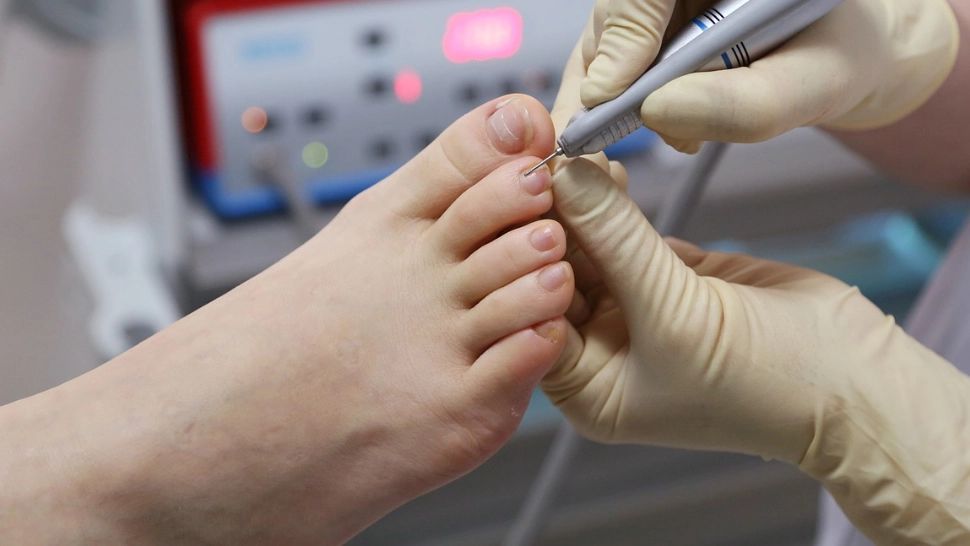 Cum poți trata ciuperca unghiei, în mod natural și repede. Primele semne ale onicomicozei