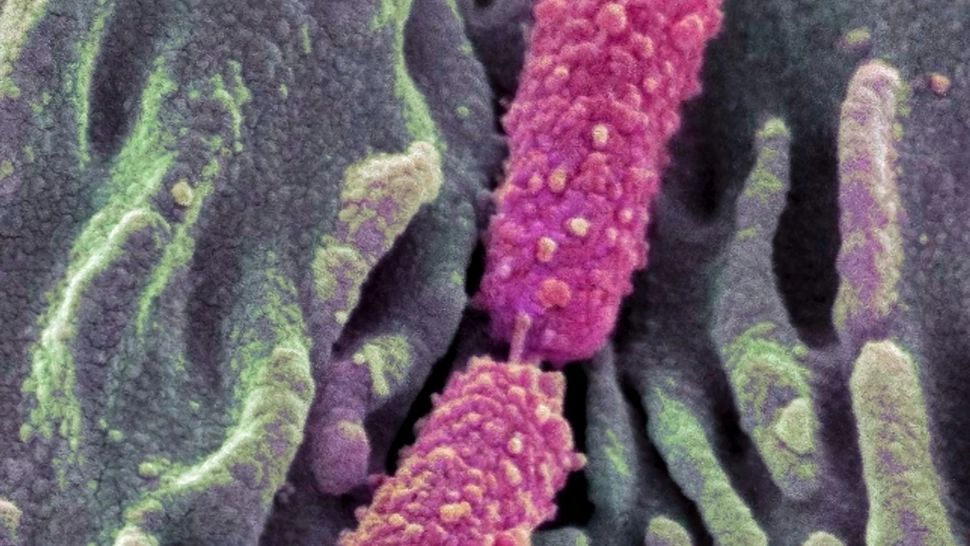 Trăiește în intestine și ar putea avea legătură cu explozia cancerelor colorectale la tineri