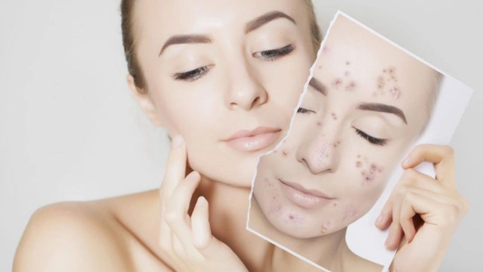 Trucul natural care te scapă de acnee. Tenul tău va arăta FABULOS