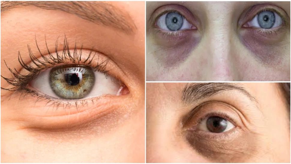 Boala care se ascunde în spatele cearcănelor. Semnalul care îți indică că e momentul să mergi la medic 