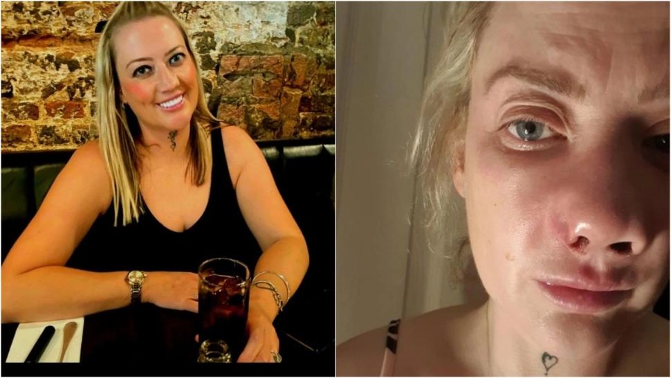 Un coșmar în loc de zâmbet: drama unei femei desfigurate după un tratament dentar ieftin în Turcia