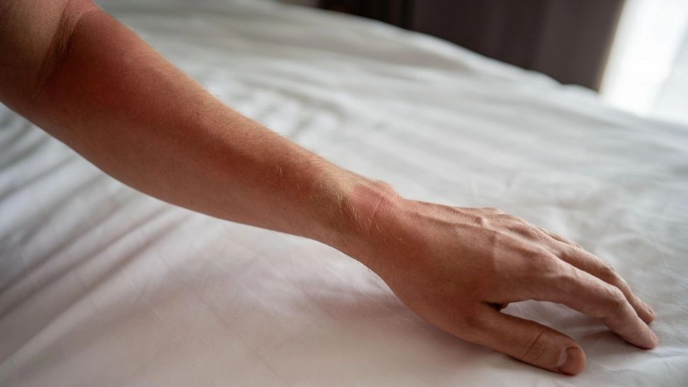 Cum se manifestă alergia la soare