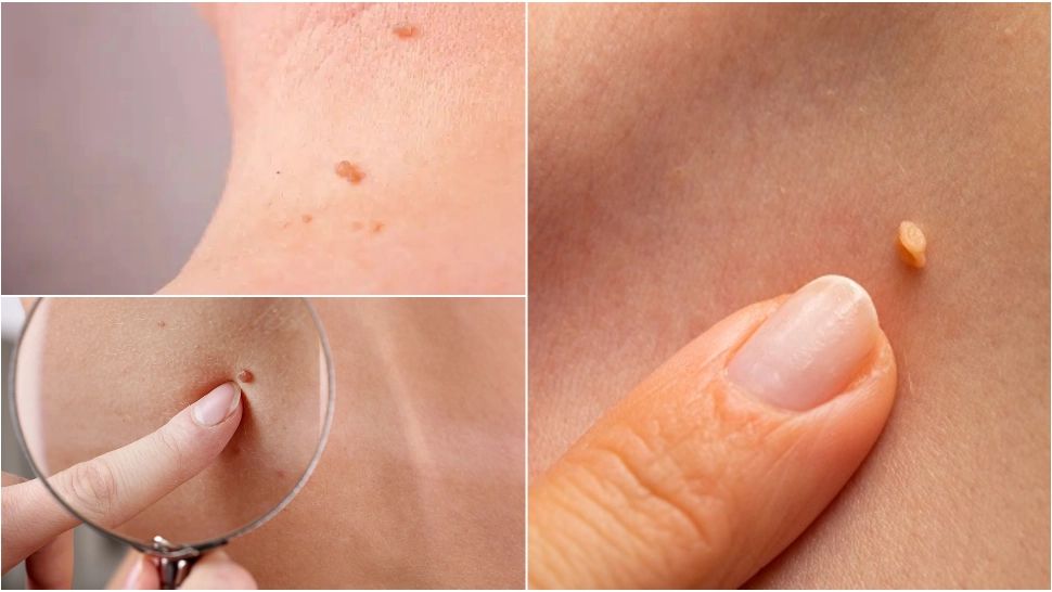 Ce sunt papiloamele și cât de periculoase pot fi. Iată cum poți scăpa de ele 