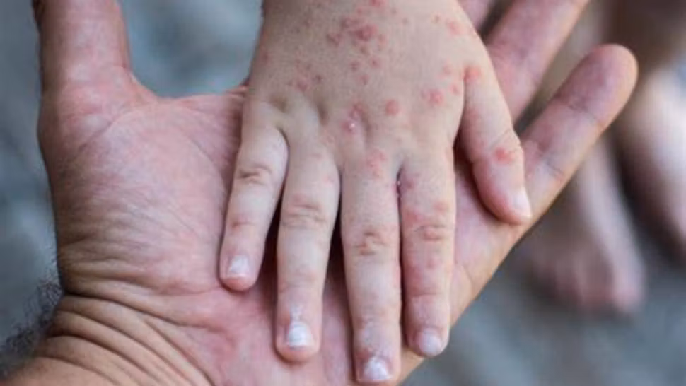 Caz neașteptat: un copil a murit la câțiva ani după ce s-a vindecat de rujeolă. Afecțiunea SSPE care i-a adus sfârșitul