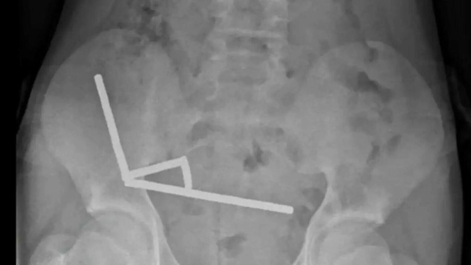 Caz șocant: un băiat de 13 ani, operat de urgență după ce a înghițit aproape 200 de magneți