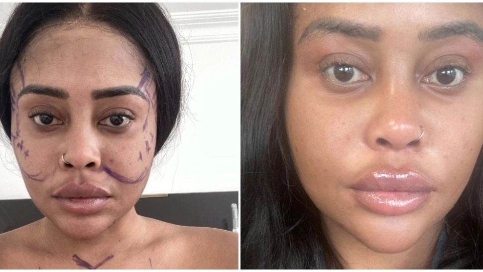 O avocată de 28 de ani a cheltuit peste 56.000 de euro pe operații estetice: „A fost o investiție în mine”