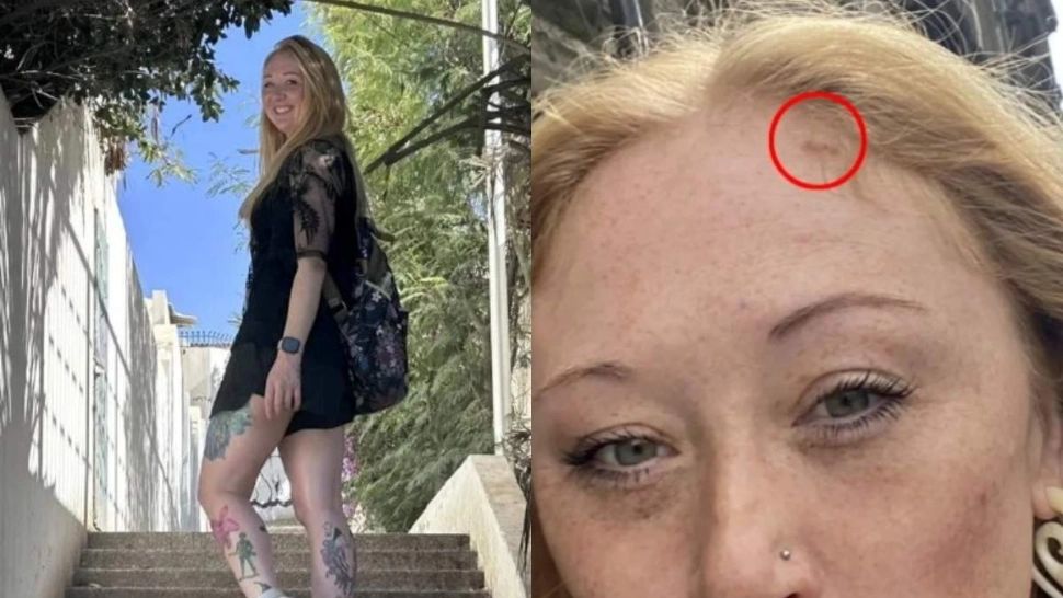 A aflat că are cancer de piele după ce a mers la solar. O artistă a trecut prin 13 intervenții chirurgicale după diagnostic