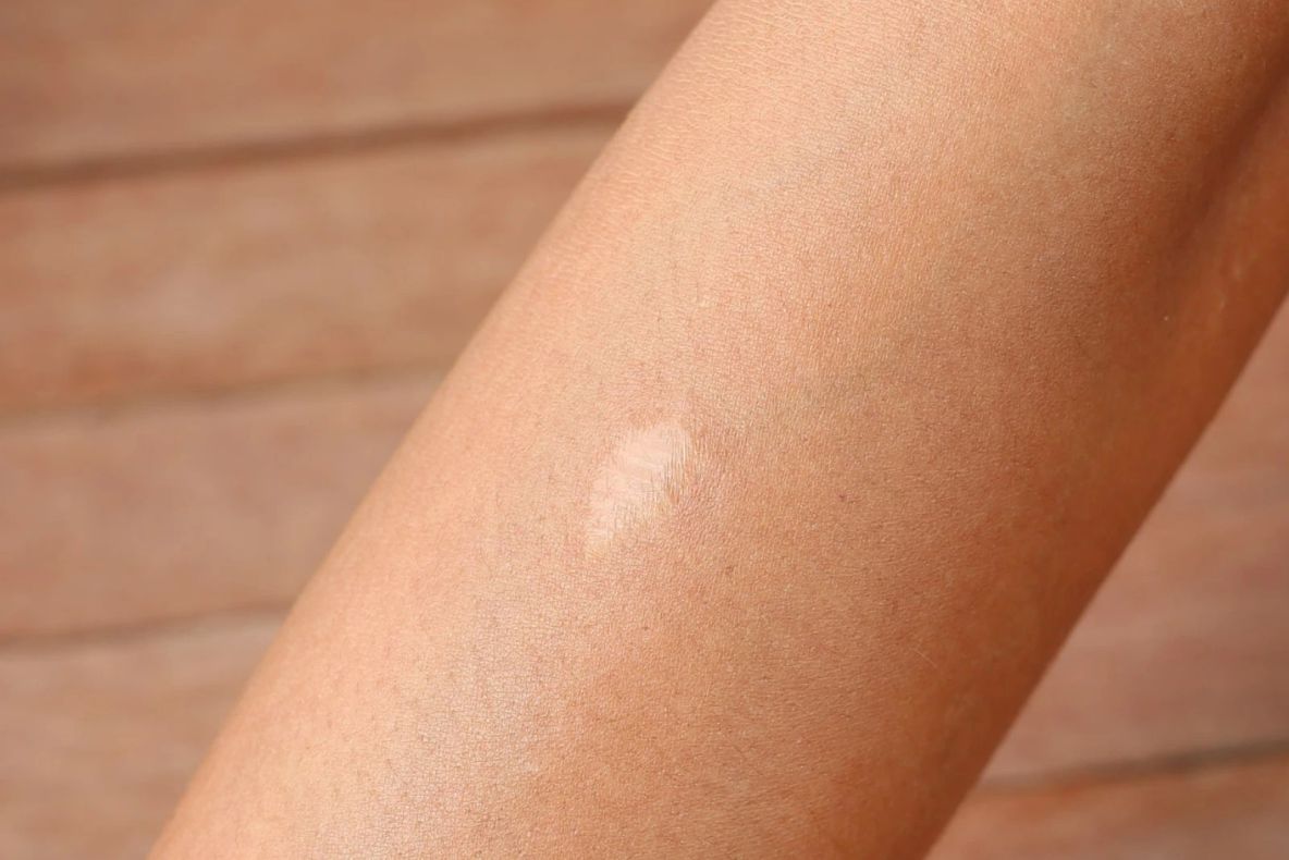 Cum scapi de cicatrici. Remediul natural care le șterge ca prin magie 