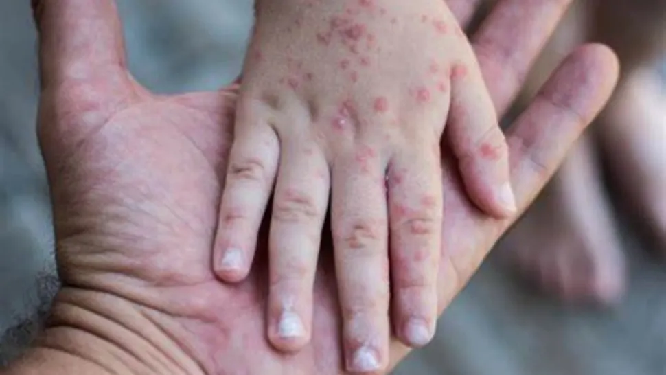 Mii de cazuri de rujeolă, după scăderea ratei de vaccinare