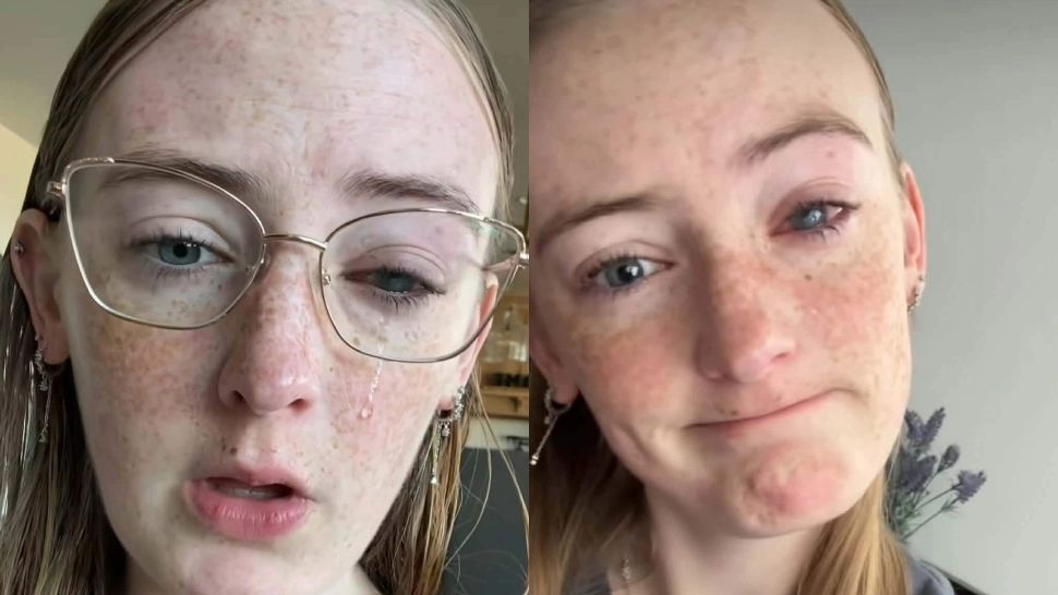 Tânără de 20 de ani, afectată grav după ce a purtat lentile de contact: a orbit parțial după o infecție periculoasă la ochi