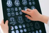 Premieră medicală la Londra: prima operație de creier asistată de inteligență artificială i-a salvat vederea unui bărbat
