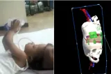 Premieră medicală: gemene siameze unite la nivelul craniului, separate cu ajutorul inteligenței artificiale. Povestea impresionantă a surorilor