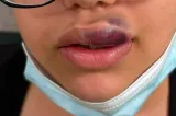 O adolescentă din Oradea a vrut să-și mărească buzele dar a ajuns de urgență la spital. Țesutul era în pericol de necrozare