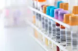 România, în topul UE la diagnostice HIV tardive. Peste 60% dintre cazuri sunt depistate în stadii avansate