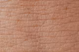 Vitamina asociată cu un risc mai mic de cancer de piele. Ce spun dermatologii