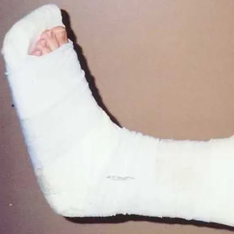 Medicii englezi au inventat "osul injectabil"