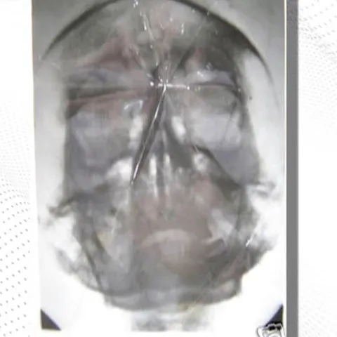 Un american a scos la licitaţie 2 radiografii craniene ale lui Hitler 
