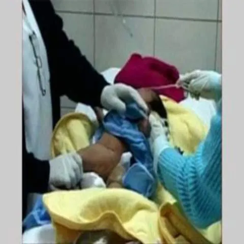 Succes în lumea medicală! O fetiţă cu trei picioare a fost operată la doar nouă zile de la naştere