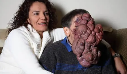 Top 10 cele mai oribile tumori - ATENŢIE, IMAGINI ŞOCANTE!
