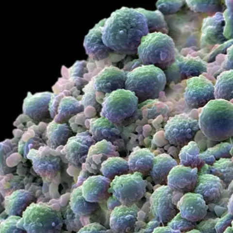 Descoperire medicală: Terapia cu nanoparticule distruge tumorile canceroase fără a afecta sistemul imunitar