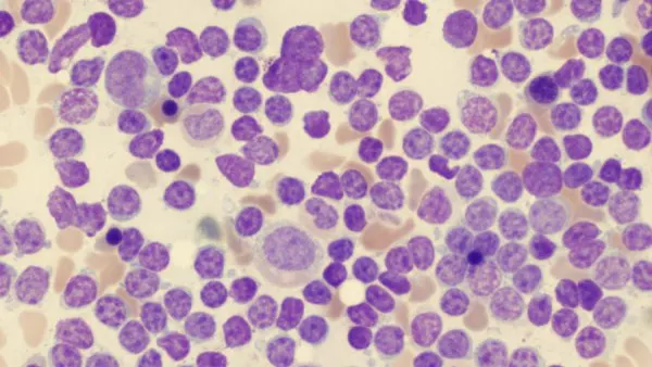 Semne de alarmă care anunță leucemia. Mare atenţie la aceste simptome!
