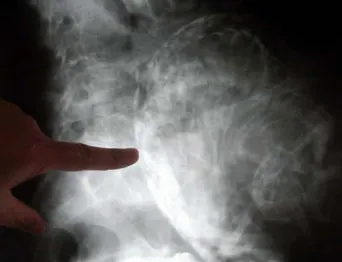 Femeia care a ULUIT medicina. A ţinut un făt în pântece timp de 60 de ani 