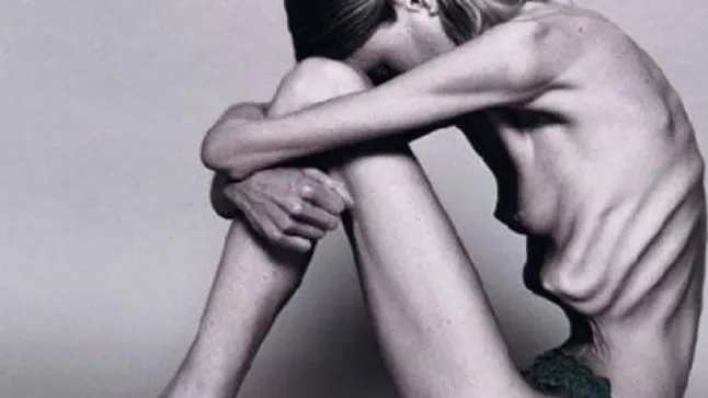 Povestea dramatică a femeii de 47 de ani, care este anorexică şi vrea să fie ajutată să moară / Arhivă foto