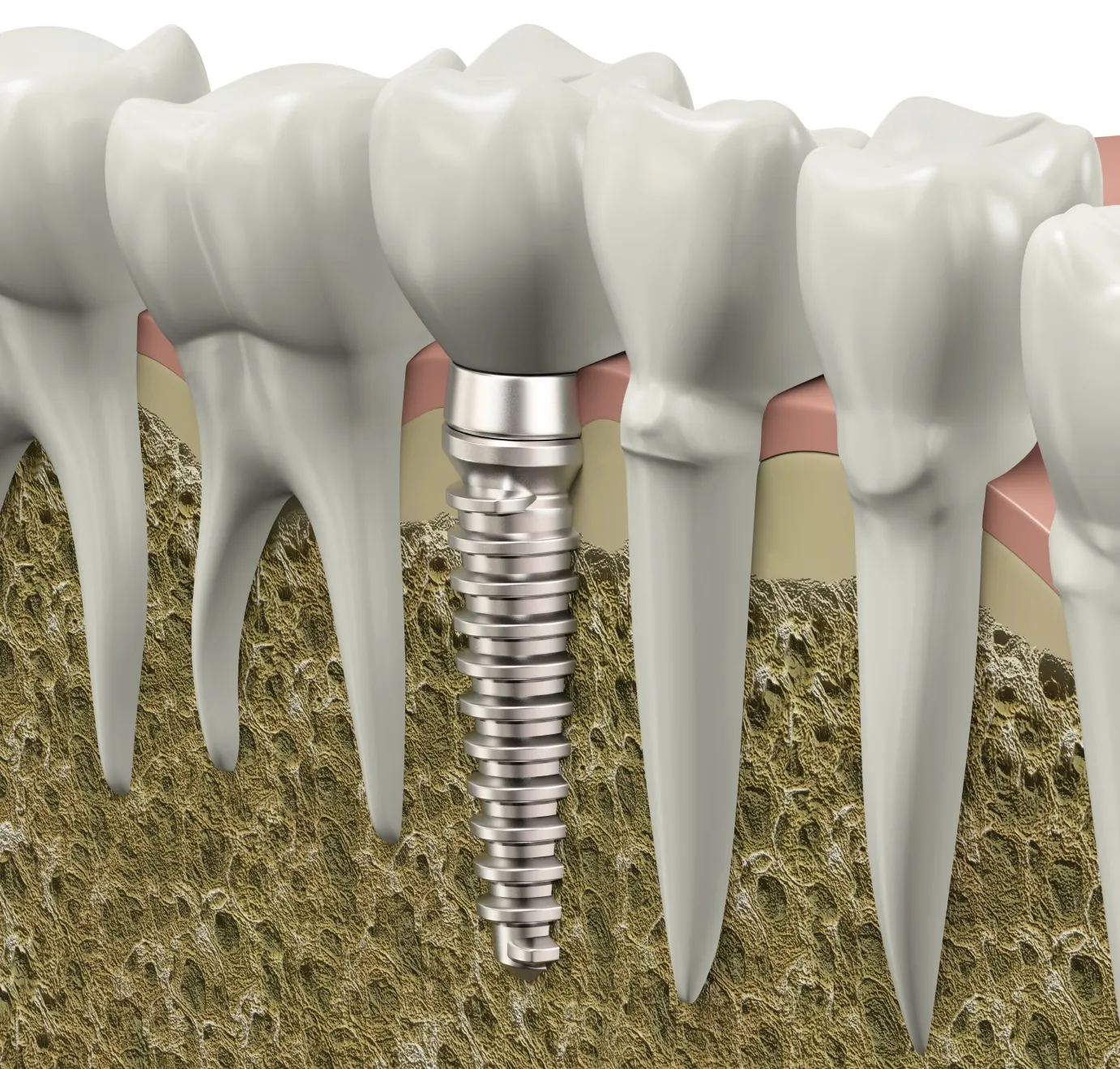 SĂNĂTATE. 5 mituri despre implantul dentar