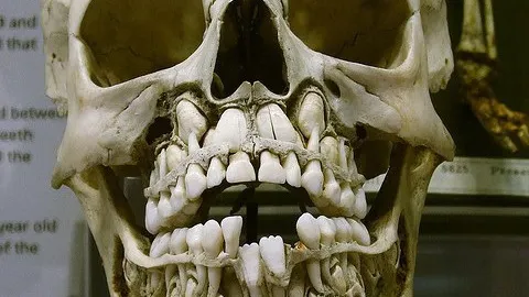 Cel mai bizar craniu. Deşi e şocant, medicii spun că este perfect normal