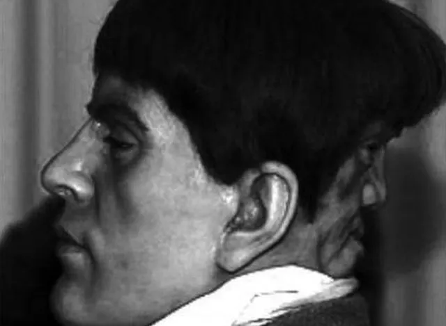 Medicii au ramas şocati: omul care s-a născut cu doua feţe