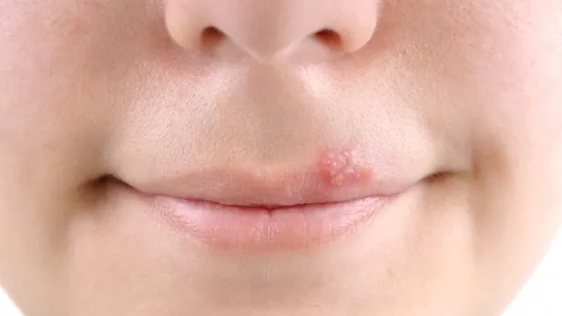 Faci HERPES? Trebuie să ştii asta: ai RISC DUBLU pentru o BOALĂ FĂRĂ LEAC