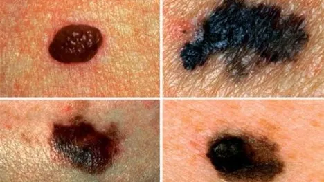 Semne de alarmă care arată că o aluniță s-a tranformat în cancer